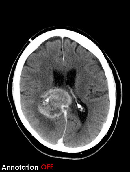 CT brain - Butterfly glioma