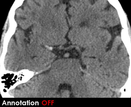 CT brain - insular ribbon/dense MCA sign