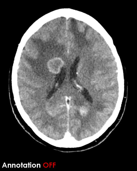 CT brain - metastases