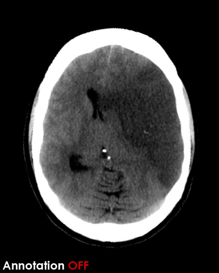 CT brain - Large MCA infarct