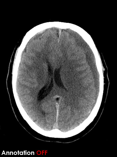 CT brain - subdural haematoma