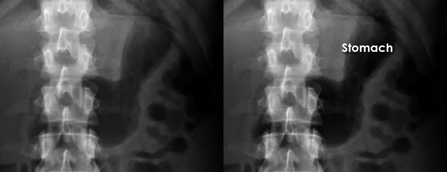 abdominal-x-ray-system-and-anatomy-bowel-gas-pattern