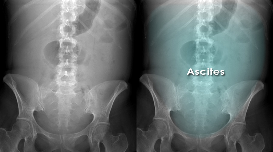 Ascites On Abdominal X Rays