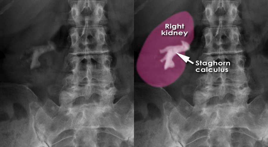 kidney-stones-xray