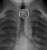 abdomen_xray_coin_ap_thumb.jpg