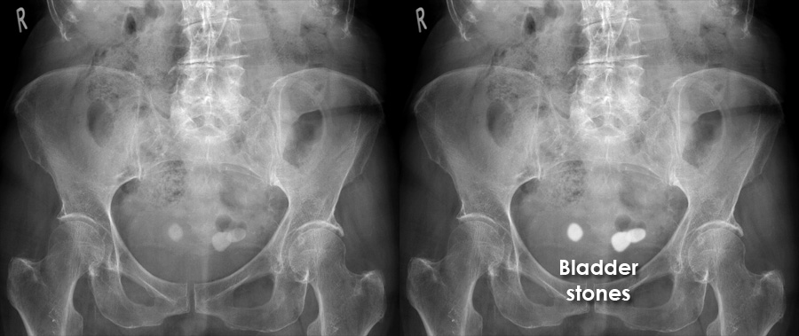 Abdominal X ray Gallery Calcification Bladder Stones pdf-transurethral-resection-of-bladder-tumor-healthclips-online