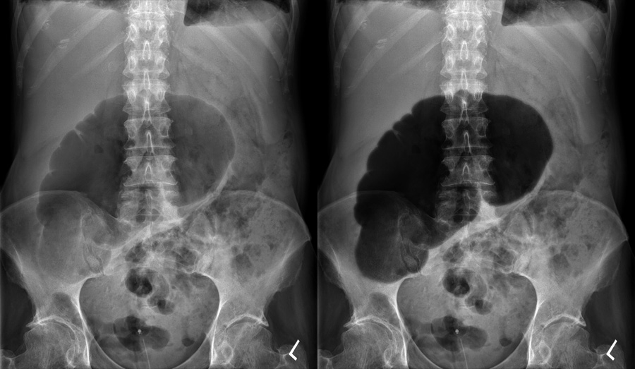 Abdominal X-ray - Abnormalities - Caecal volvulus