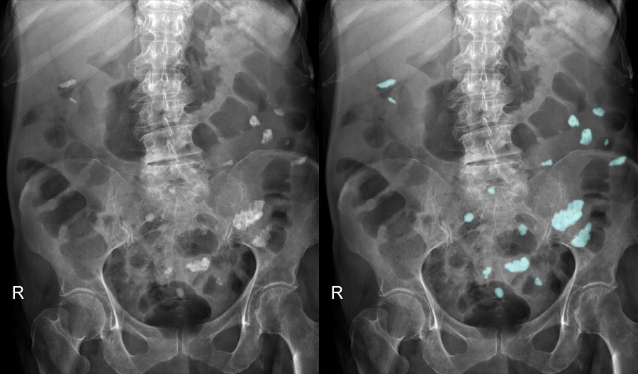 Abdominal x ray gallery calcification calcified lymph nodes