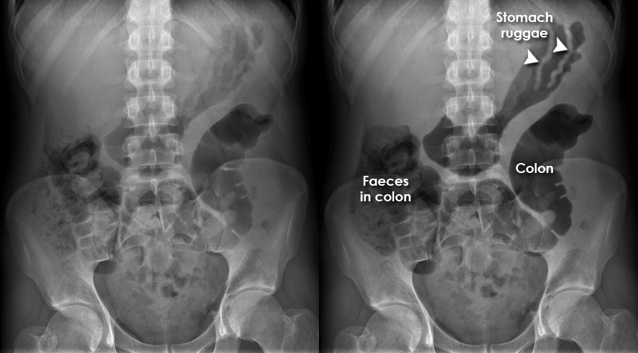 Abdominal X Ray Abnormalities Normal Reference