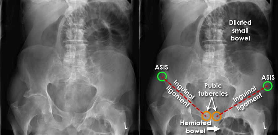 Umbilical hernia, Radiology Case