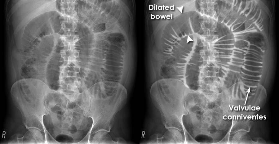 Small Bowel Obstruction X Ray Small Bowel Obstruction Film X Ray Small Bowel Obstruction X Ray Small Bowel Obstruction Film X Ray