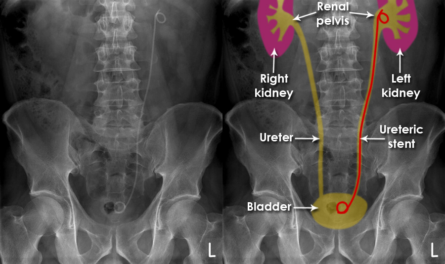 abdominal-x-ray-artifacts-renal-and-ureteric-stents