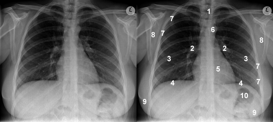 normal chest xray labeled