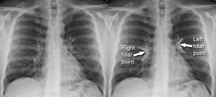 normal chest xray labeled