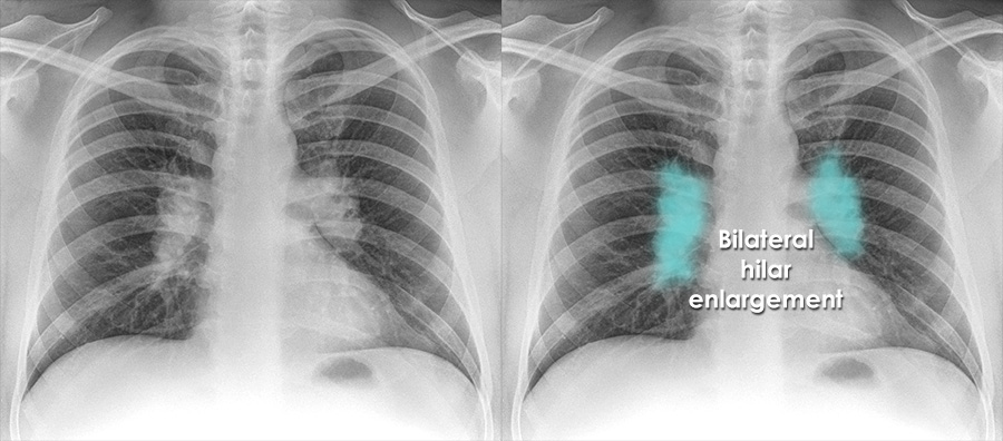 hilum of lung