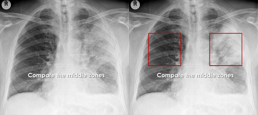 Healthy Lungs Vs Smokers Lungs X Ray Healthy Lungs Vs Smokers Lungs X Ray