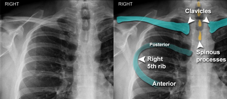 normal chest xray labeled