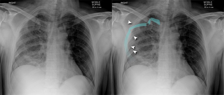 broken-sternum-x-ray
