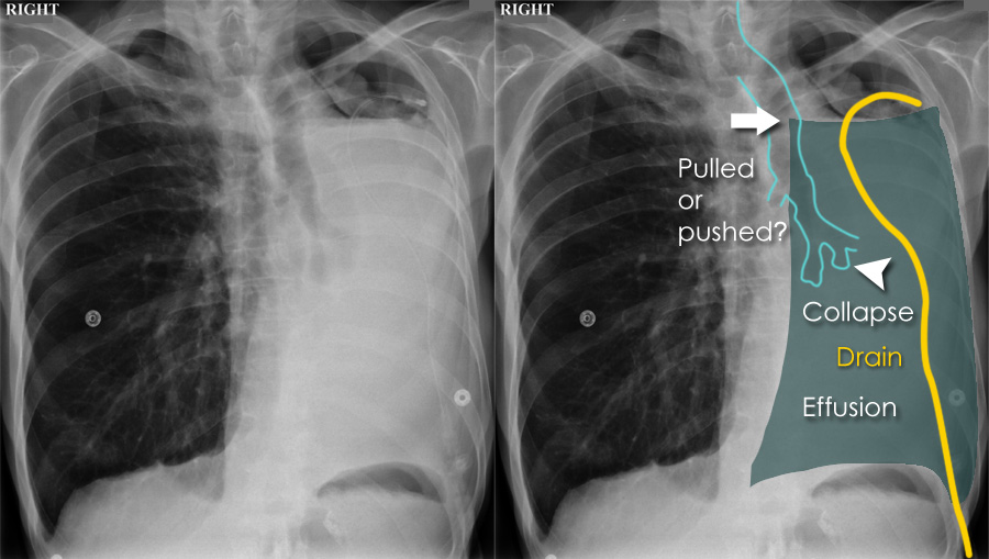 Meniscus sign pleural effusion
