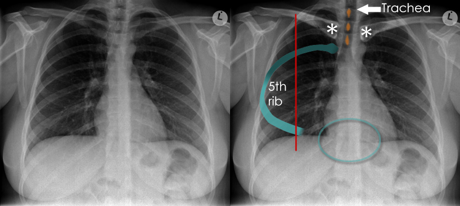 Chest X-ray - Airways and lung collapse - Normal chest X-ray