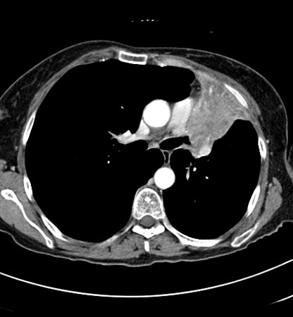 vol_loss_mass_phrenic_palsy_ct_thumb.jpg