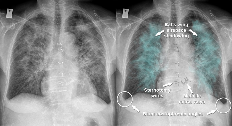 Pulmonary Edema Chest X Ray Pulmonary Edema Chest X Ray