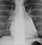 upper chest passmaker inplantation upper chest passmaker inplantation
