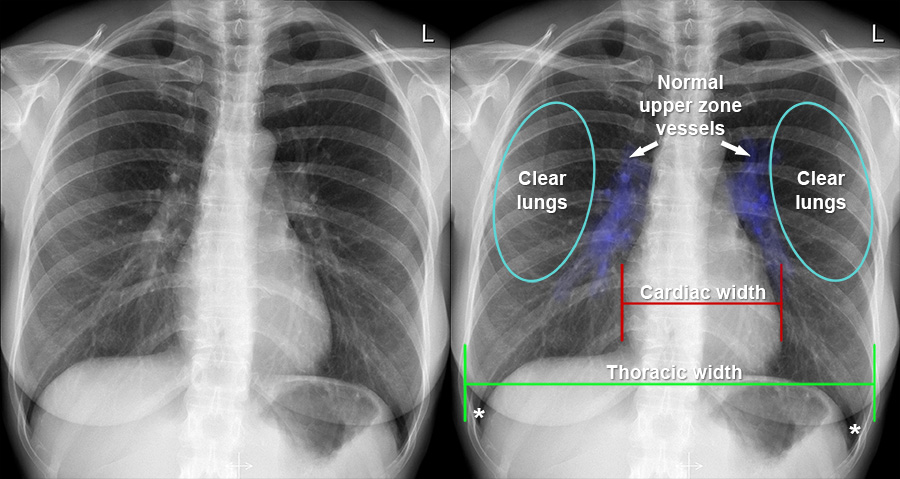 Chest X-ray - Cardiac disease - Normal heart
