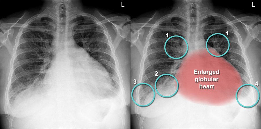 Pericardial Effusion X Ray Pericardial Effusion RadRounds Radiology Pericardial Effusion X Ray Pericardial Effusion RadRounds Radiology