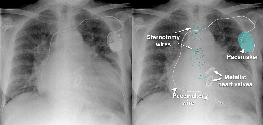 X Ray Heart x-ray-heart