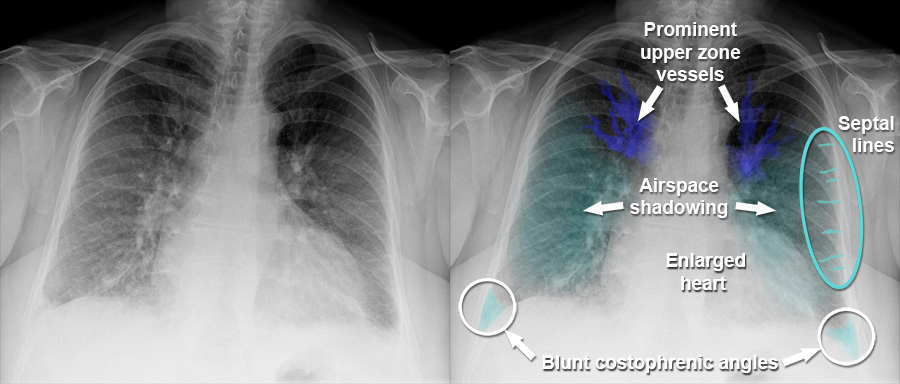 Pulmonary Veins Xray pulmonary-veins-xray