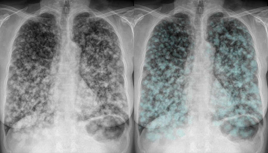 Small Cell Lung Cancer Chest X Ray