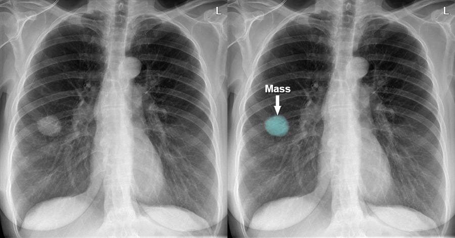 Chest X Ray Lung Cancer Response To Radiotherapy