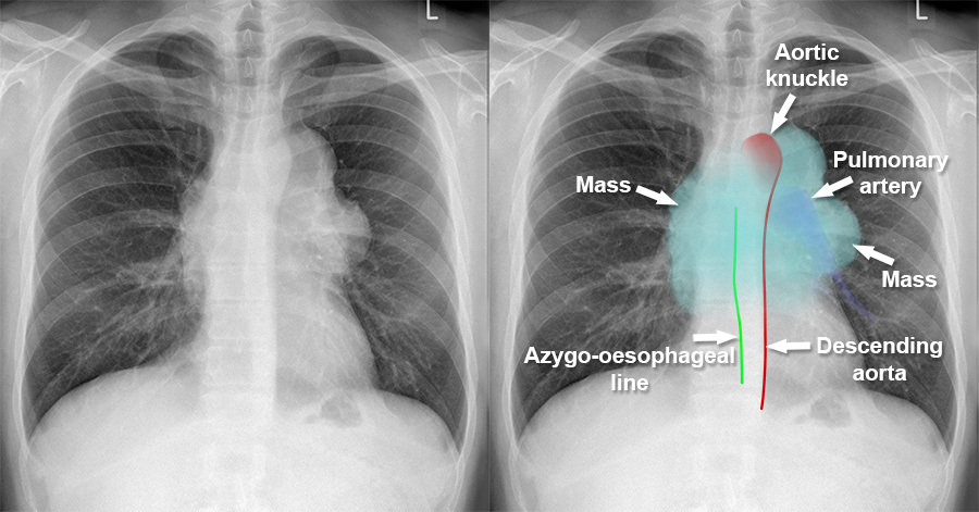 chest-x-ray-mediastinum-and-hilum-anterior-mediastinal-mass