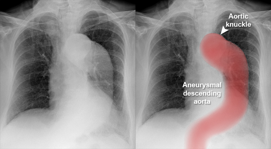 Thoracic Aortic Aneurysm Xray Thoracic Aortic Aneurysm Xray