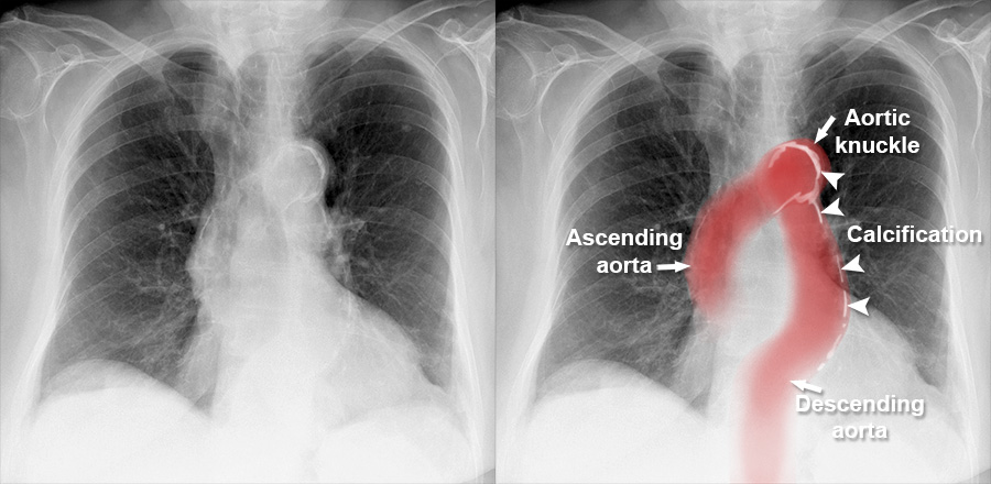 Aortic Calcification On Chest X Ray - vrogue.co