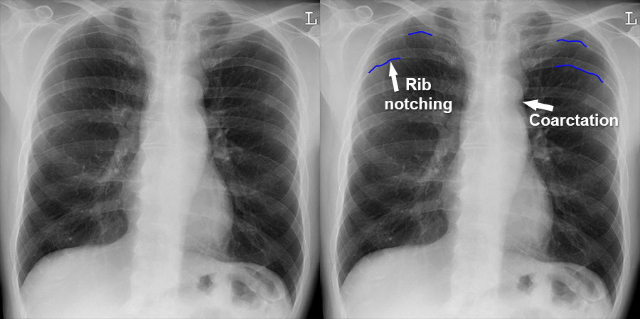 Chest X Ray Mediastinum And Hilum Coarctation Of The Aorta