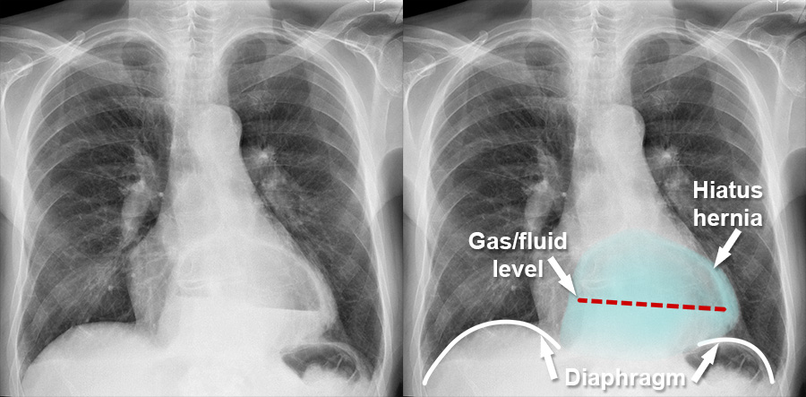 Chest X ray Mediastinum And Hilum Hiatus Hernia chest-x-ray-mediastinum-and-hilum-hiatus-hernia