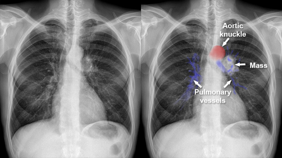 Chest X Ray Mediastinum And Hilum Unilateral Hilar Enlargement