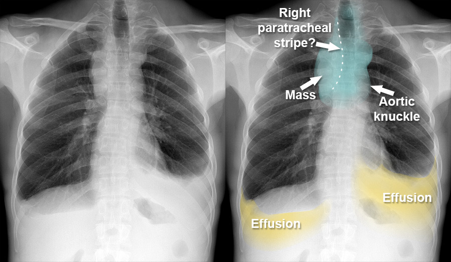 Chest X Ray Mediastinum And Hilum Superior Mediastinal Mass