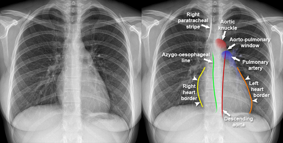 Chest X Ray Mediastinum And Hilum Normal Mediastinal Contours