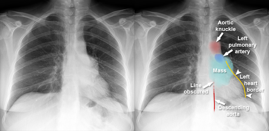 posterior-mediastinum