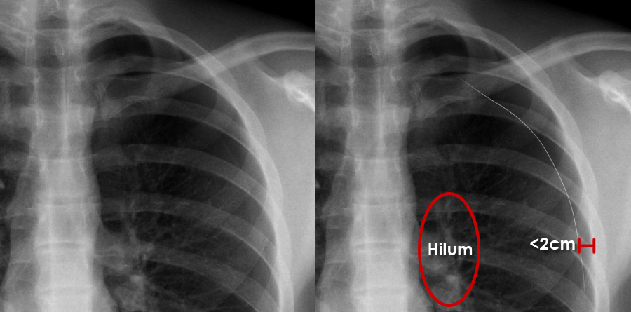 Small Pneumothorax Chest X Ray