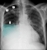 cxr_gall_adh_thumb.jpg