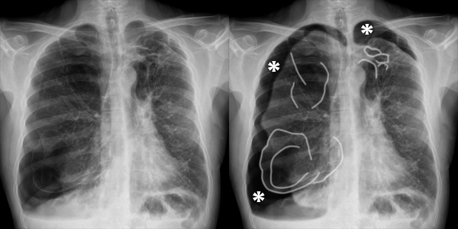 Chest X-ray - Pneumothorax gallery - COPD bilateral pneumothoraces