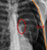 cxr_pneumothorax_large_thumb.jpg