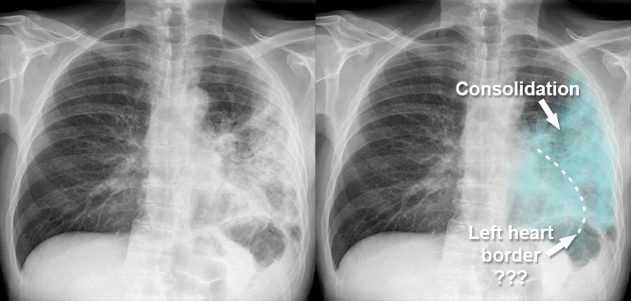 chest x ray pneumonia