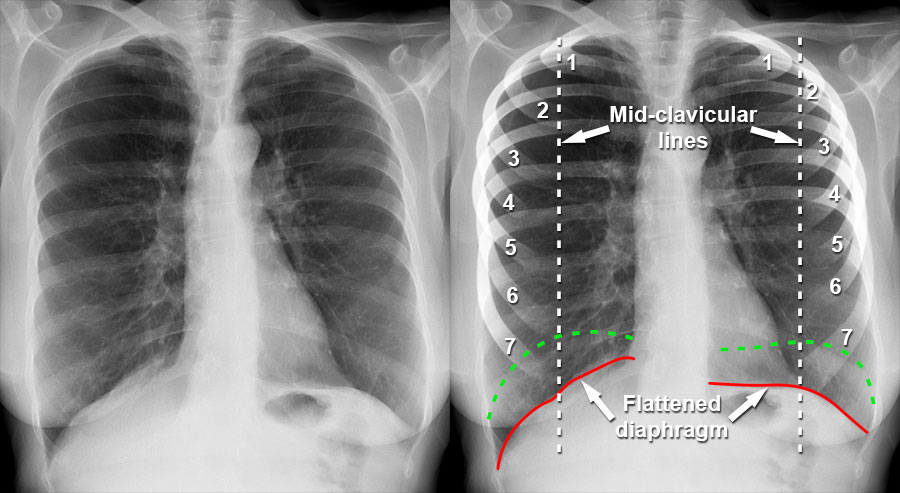 Emphysema Symptoms Lung Cancer Symptoms