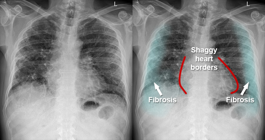 Fibrosis Chest X Ray