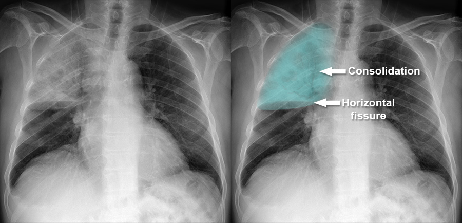Chest X-ray - Pulmonary disease - Consolidation - Lobar
